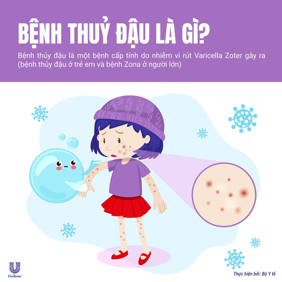 Bệnh Thuỷ đậu