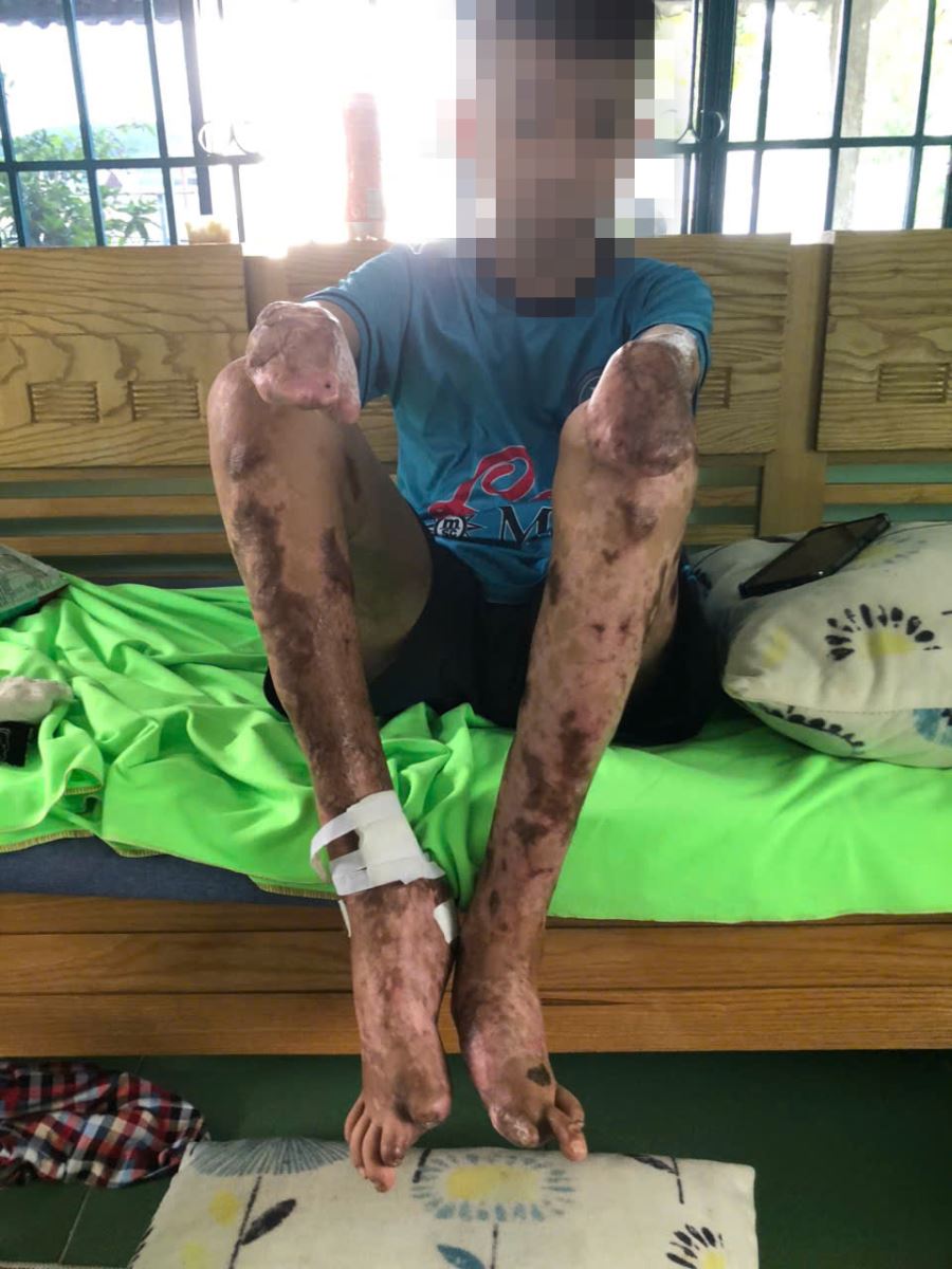 Do biến chứng để lại nên bệnh nhân phải loại bỏ 2 bàn tay và 2 ngón chân cái.