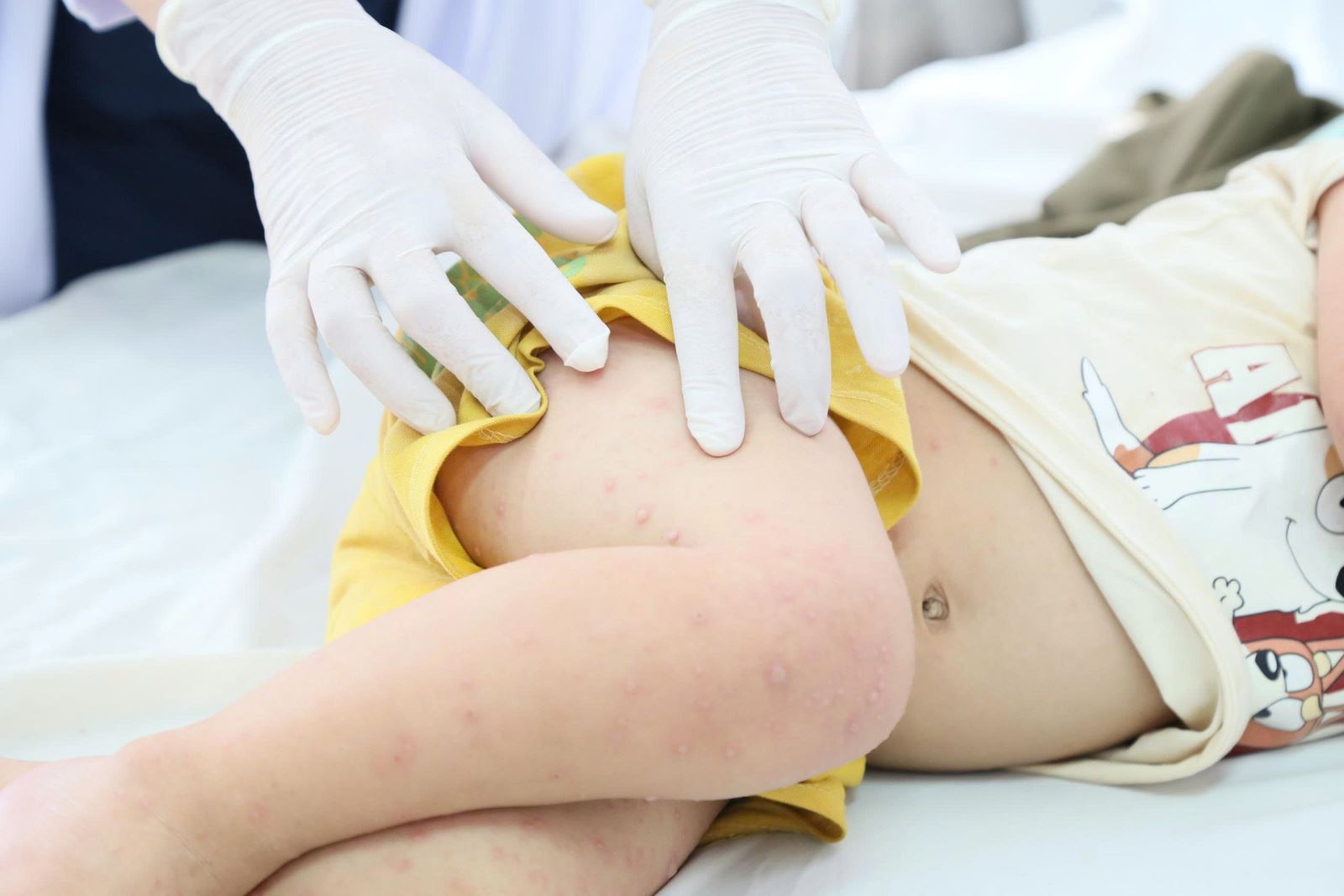 Bệnh tay chân miệng gây ra nhiều biến chứng nguy hiểm cho sức khoẻ của trẻ.