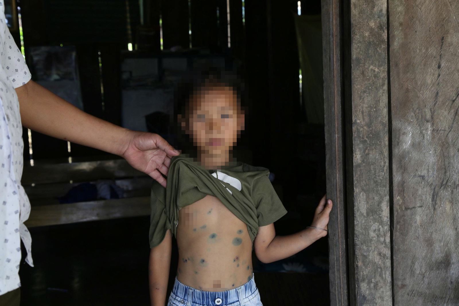 Trung tâm Kiểm soát dịch bệnh tỉnh Đắk Lắk điều tra dịch tễ và xác định ca bệnh thủy đậu đầu tiên điểm trường Lê Văn Tám tại thôn 20 xã Ea Riêng là cháu S.T.B.