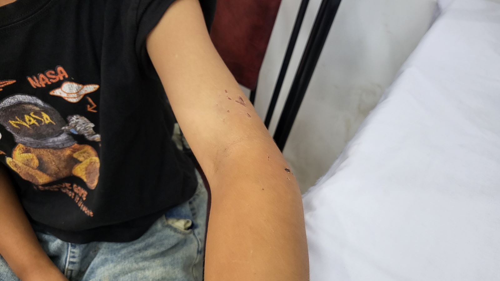 các trường hợp bị cắn cần xử lý vết thương và tiêm phòng kịp thời.