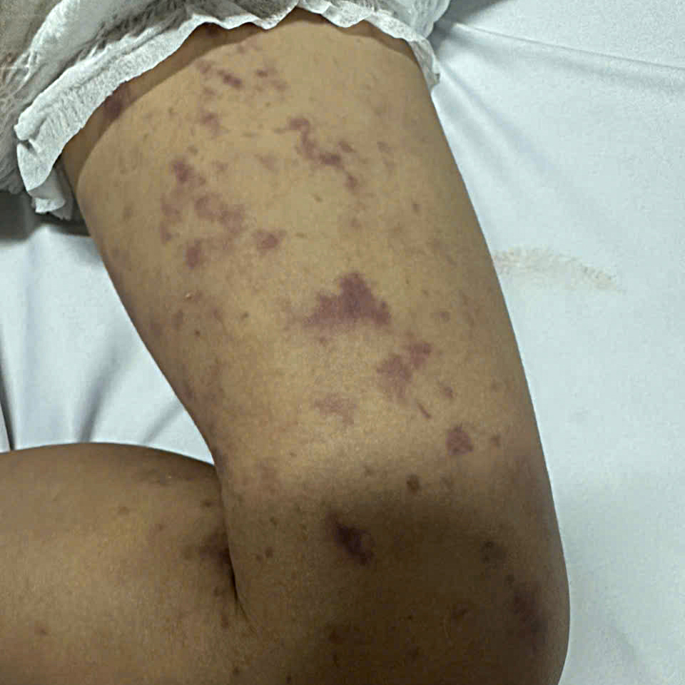 Bệnh nhi mắc viêm não mô cầu xuát hiện những nốt tử ban hình sao khắp cơ thể.